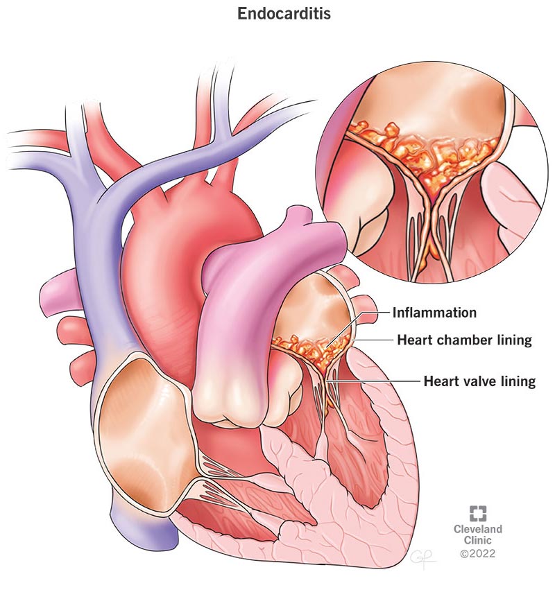 Illustration of endocarditis.
