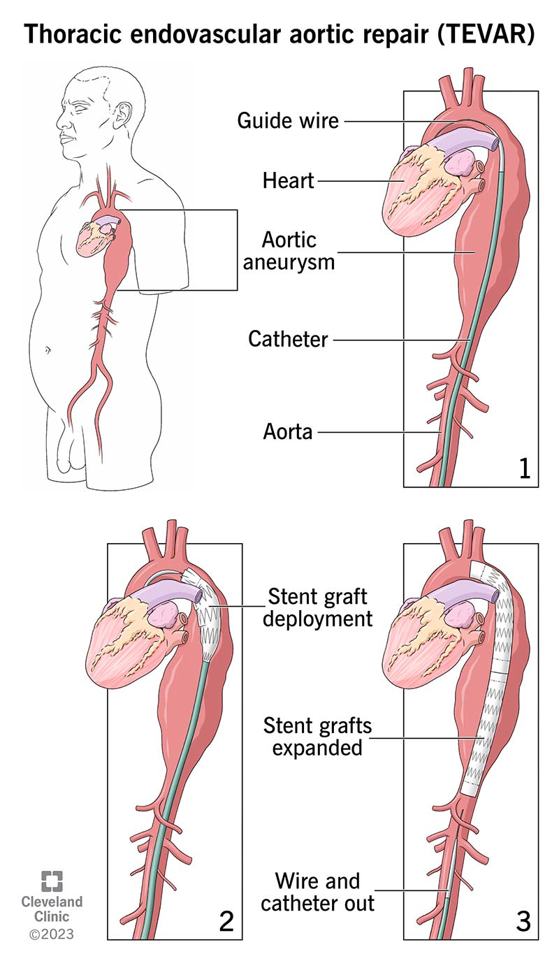 Your provider uses a catheter to deliver a stent-graft to your aorta and repair an aneurysm.