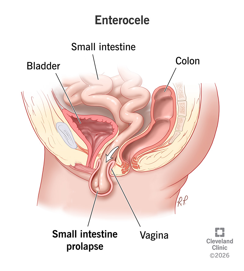 Small intestine prolapsing through vagina