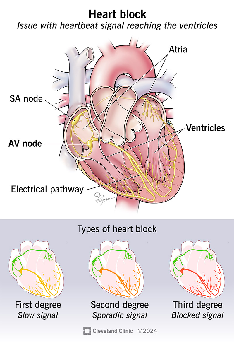 With heart block, heartbeat signals meant for your ventricles may be slow, unreliable or fully blocked.