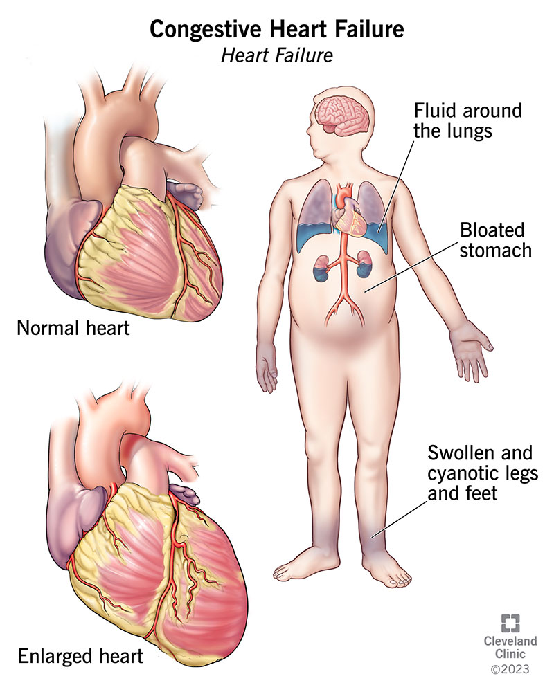 Congestive heart failure causes fluid to build up in your body because your heart isn’t pumping well.