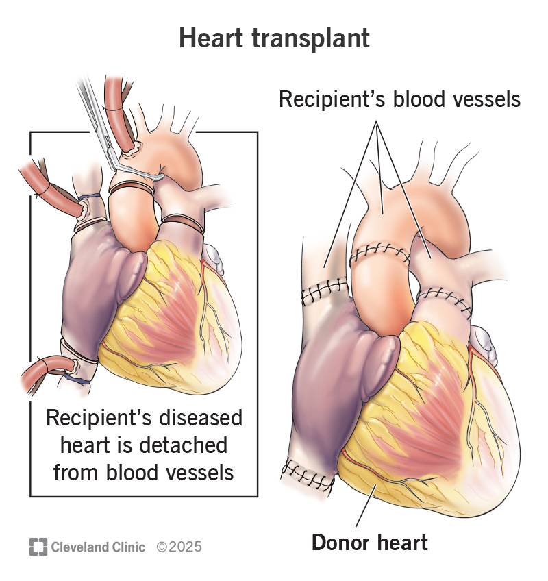 Anatomy of hearts for heart transplant, detaching the heart from its major blood vessels and replacing it with a donor