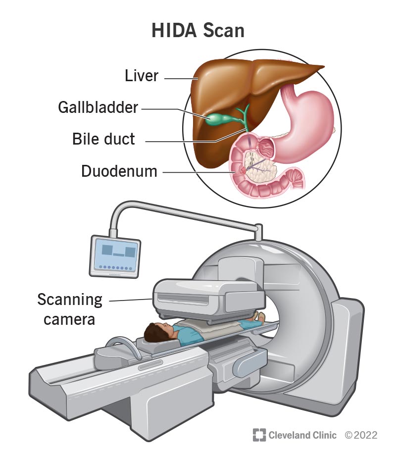 A medical drawing of the liver, gallbladder, bile duct and duodenum above a medical drawing of a HIDA scan machine. A person is laying on their back on a table attached to the machine with the machine's scanning camera directly above their abdomen.