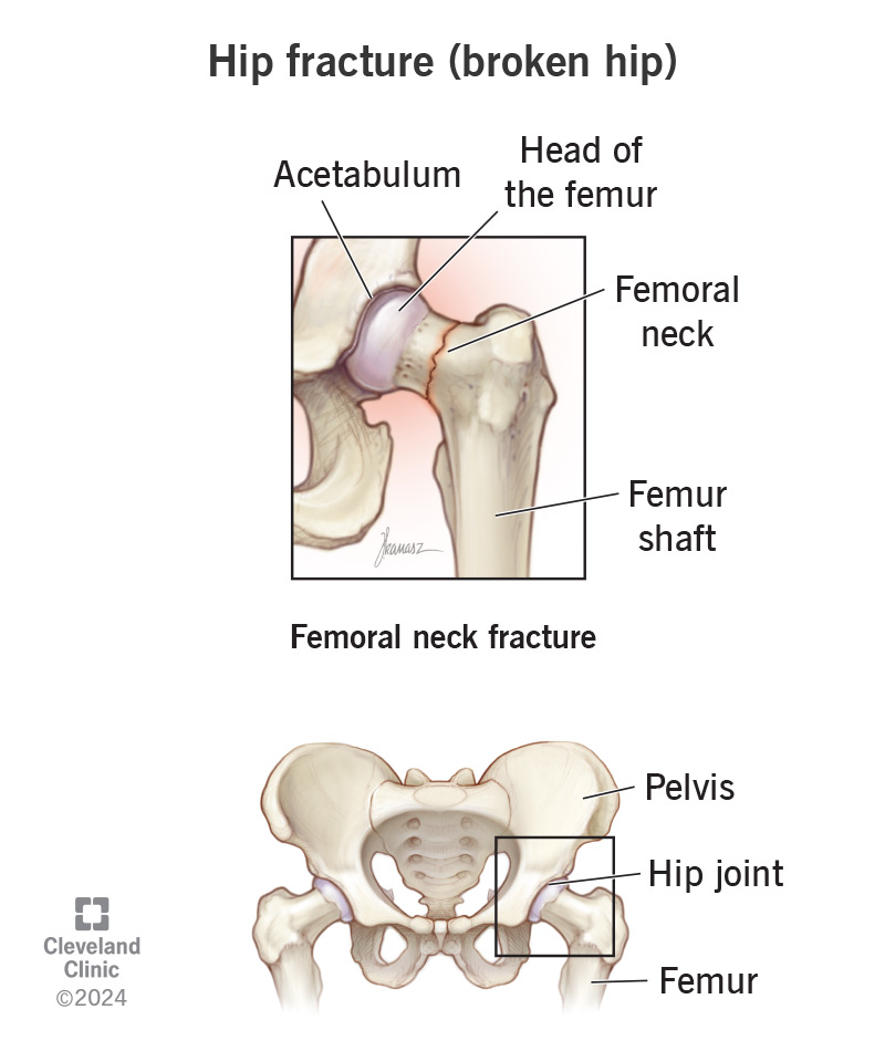 A hip fracture is breaking the upper part of your femur, near your hip joint