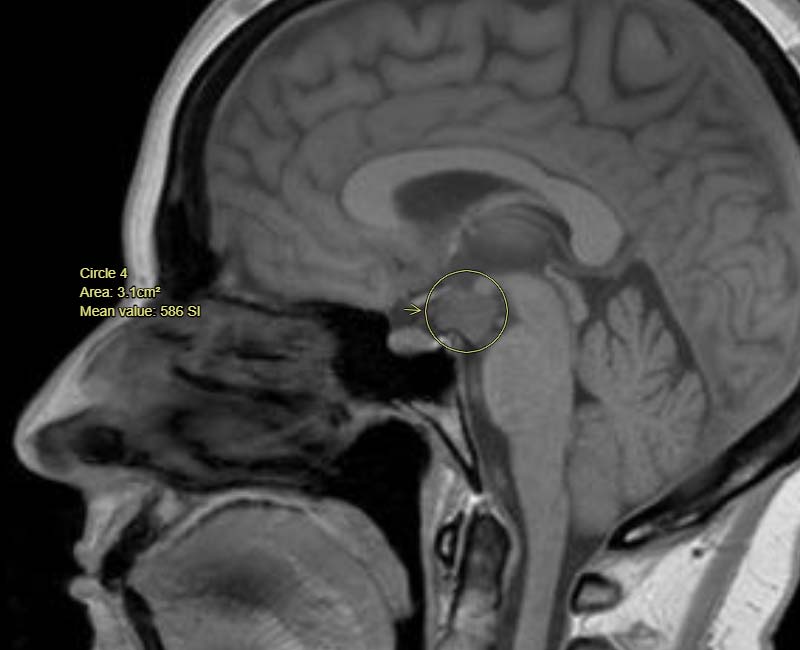 hypothalamic tumor