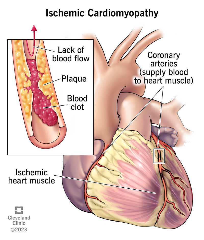 Ischemic cardiomyopathy, or damaged heart muscle from a lack of blood flow.