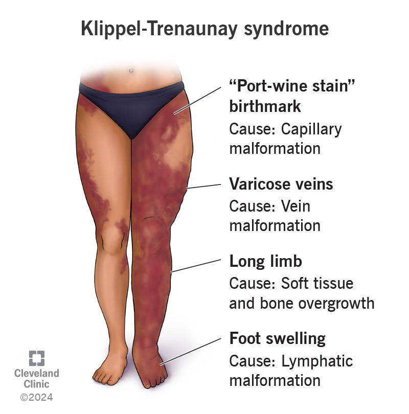 Klippel-Trenaunay syndrome symptoms include a port-wine stain, long limb and swollen foot.