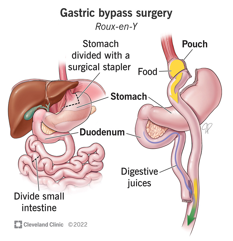 Illustration showing how gastric bypass surgery modifies the stomach and small intestine.