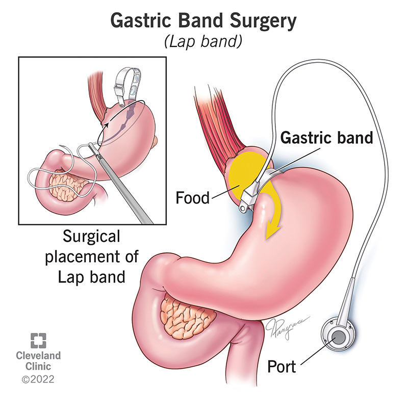Illustration of the gastric band being surgically placed around the top of the stomach.