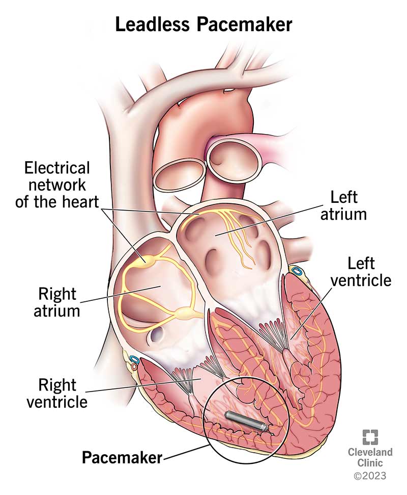 A leadless pacemaker sits in your right ventricle.