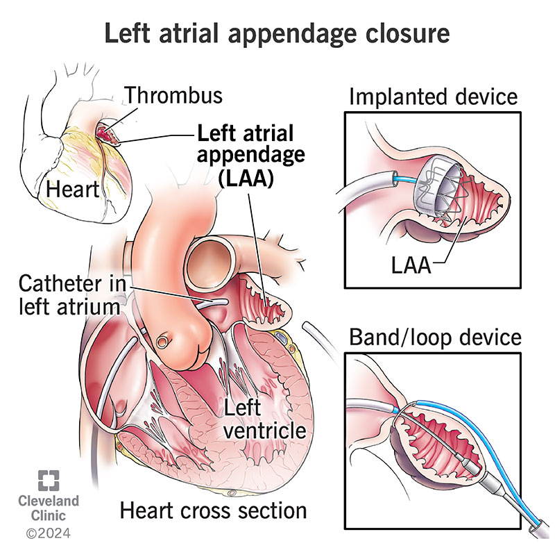 A left atrial appendage closure blocks or closes off your LAA with a device