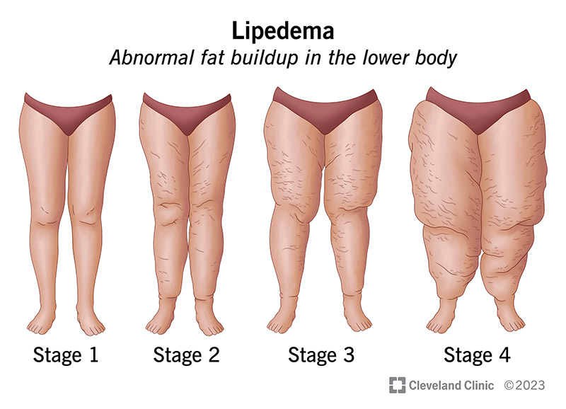 Lipedema causes abnormal fat buildup in your lower body, getting worse over time.
