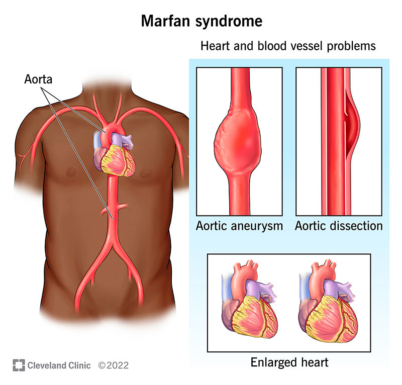 People with Marfan syndrome may have an enlarged heart and are at higher risk for aortic aneurysm and aortic dissection.