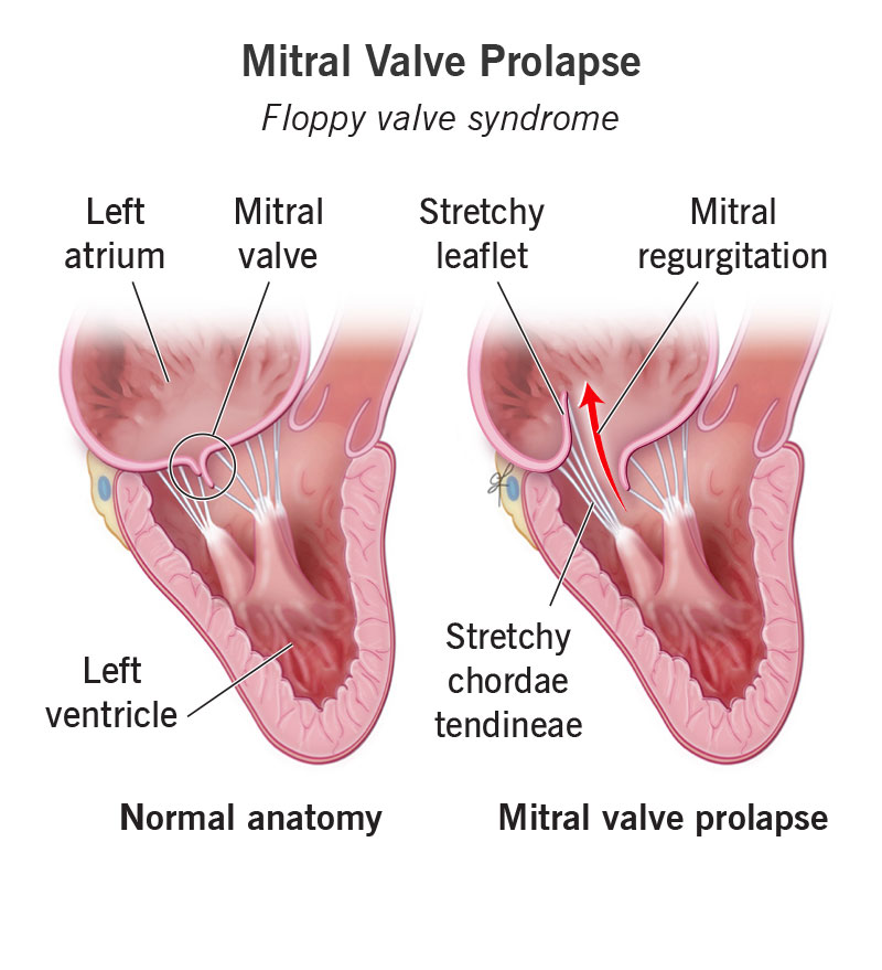 Illustration of normal anatomy compared with mitral valve prolapse.