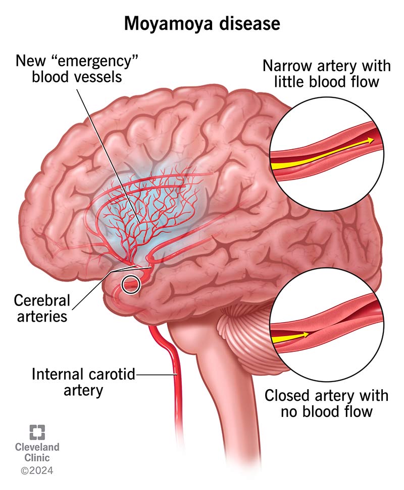 In moyamoya disease, at least one of your carotid arteries — and sometimes both — narrow or close.