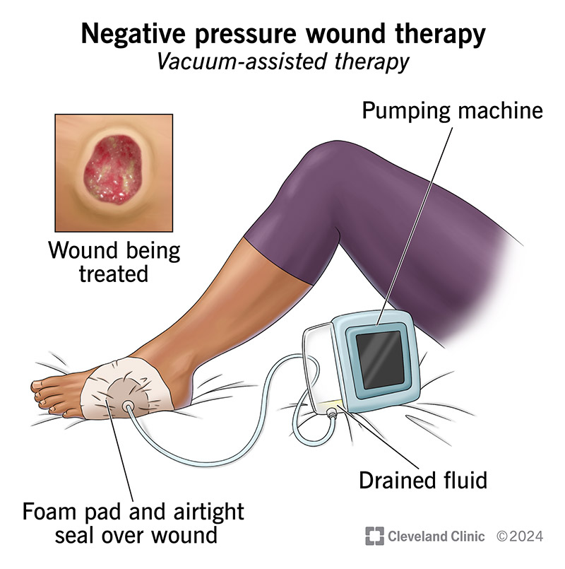 Negative pressure wound therapy, including a machine removing fluid and bacteria from a wound