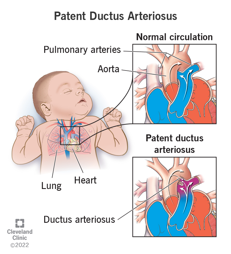 In patent ductus arteriosus, a small opening allows extra blood from the aorta to enter the baby’s lung arteries.