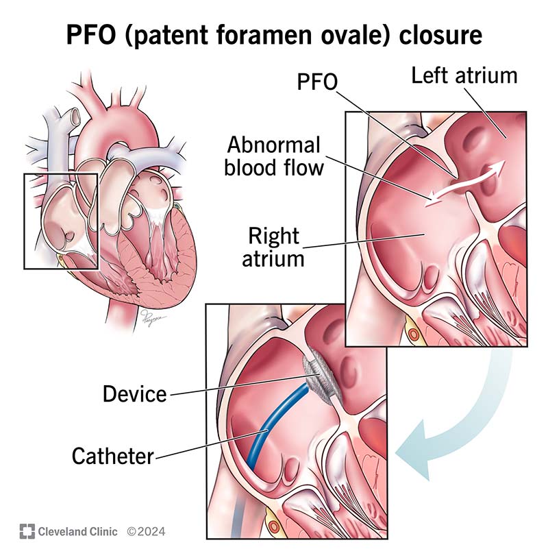 Close-up view of a heart before and after putting in a PFO closure device to stop abnormal blood flow