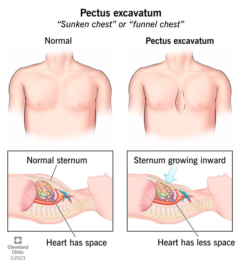 The difference between a normal chest and one with pectus excavatum is a sunken breastbone.