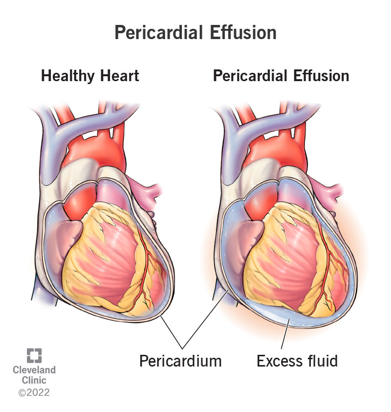 Illustration of pericardial effusion, a buildup of excess fluid around the heart.