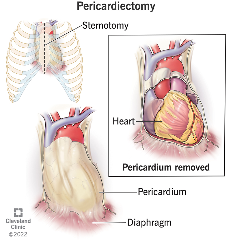 A pericardiectomy takes away the membrane sac around your heart.