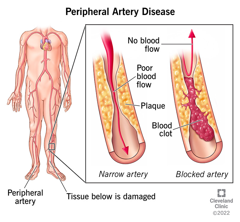 Peripheral artery disease limits blood circulation in your legs because of plaque buildup in arteries.
