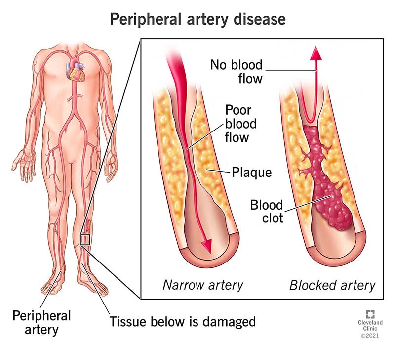  Peripheral artery disease caused by narrow and blocked arteries.