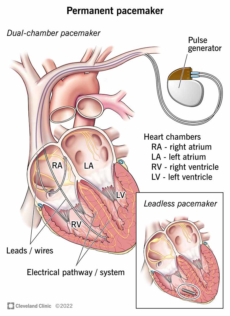 Pacemaker (for the Heart): Surgery, Types & What It Is