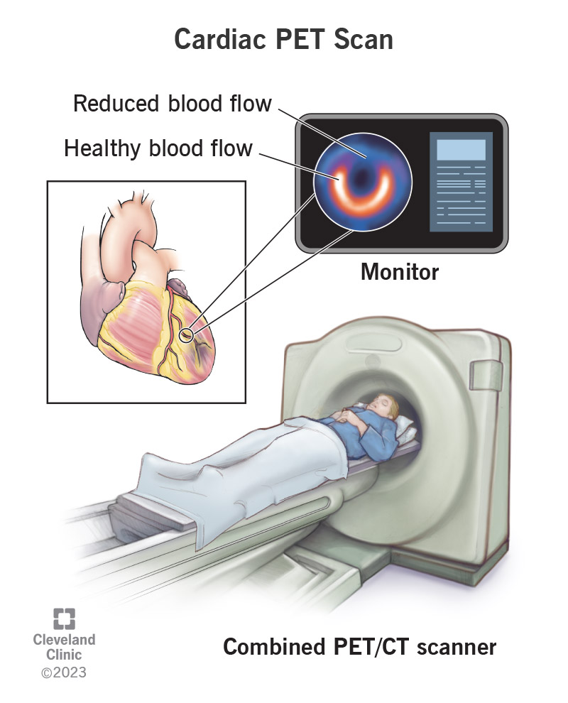 A type of cardiac PET scan showing which areas of your heart have good blood flow