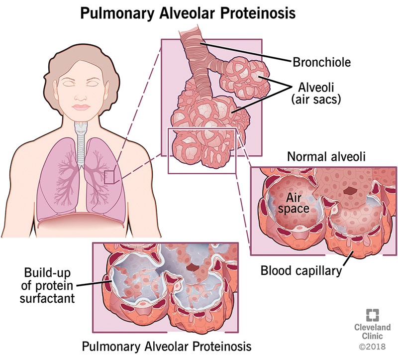 Illustration of the lungs, bronchiole, normal alveoli, blood capillary and protein surfactant buildup in alveoli with pulmonary alveolar proteinosis or PAP.