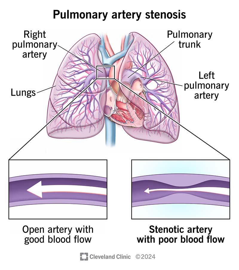 Blood flow in an open pulmonary artery compared to one with pulmonary artery stenosis.