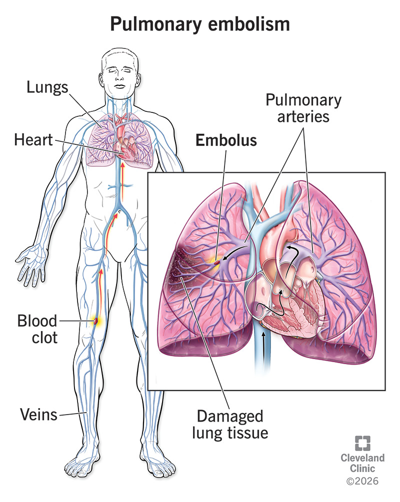Anatomy of blood vessels and lungs, with blood clot in leg vein that travels to lung artery