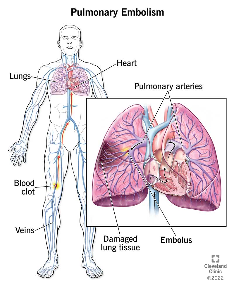 A blood clot becomes a pulmonary embolism when it travels from your leg to your lung.