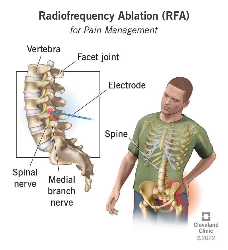 Radiofrequency ablation (RFA)