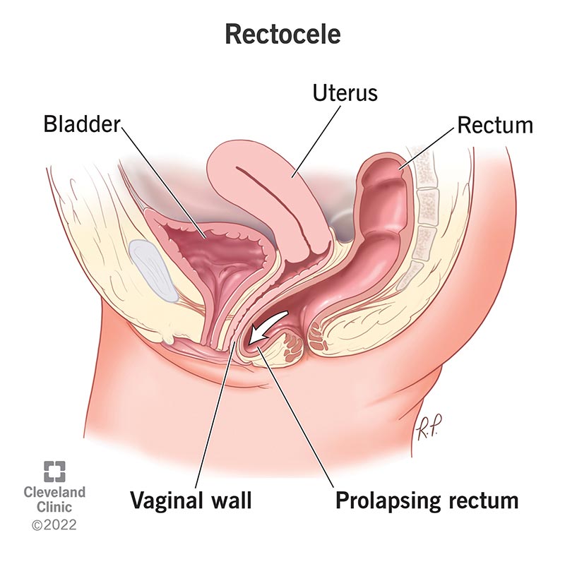 A prolapsing rectum bulges against the vaginal wall during a rectocele