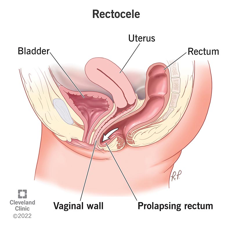 Stages of uterine prolapse. Pelvic floor muscles weakening