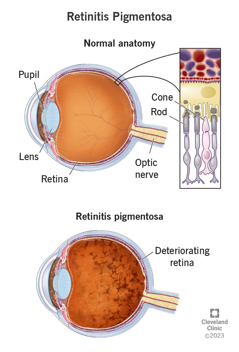 Retinitis pigmentosa affects the retina and its cones and rods; other parts of your eye include the pupil, lens and optic nerve.
