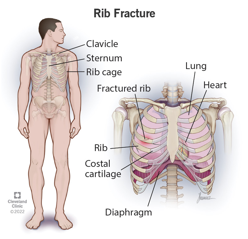 Illustrated anatomy of a ribcage and fractured rib.
