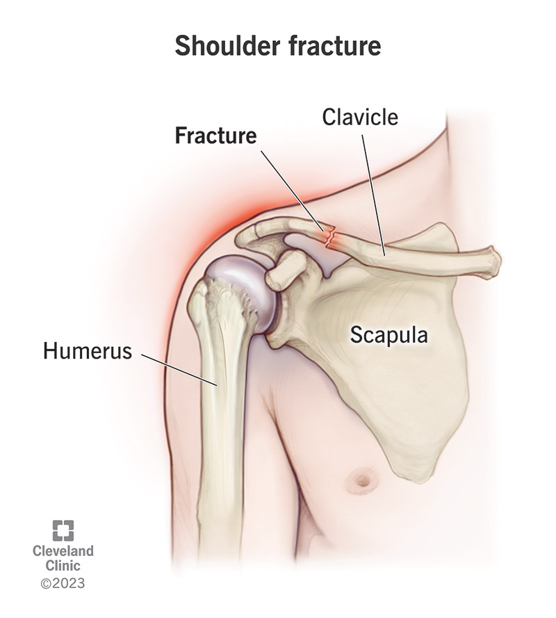 A broken clavicle (collarbone) is one type of shoulder fracture.