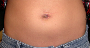 foto del abdomen después de la cirugía de puerto único que muestra poca cicatriz