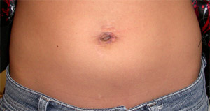 Foto des Abdomens nach einer Single-Port-Operation, das wenig Verängstigung zeigt