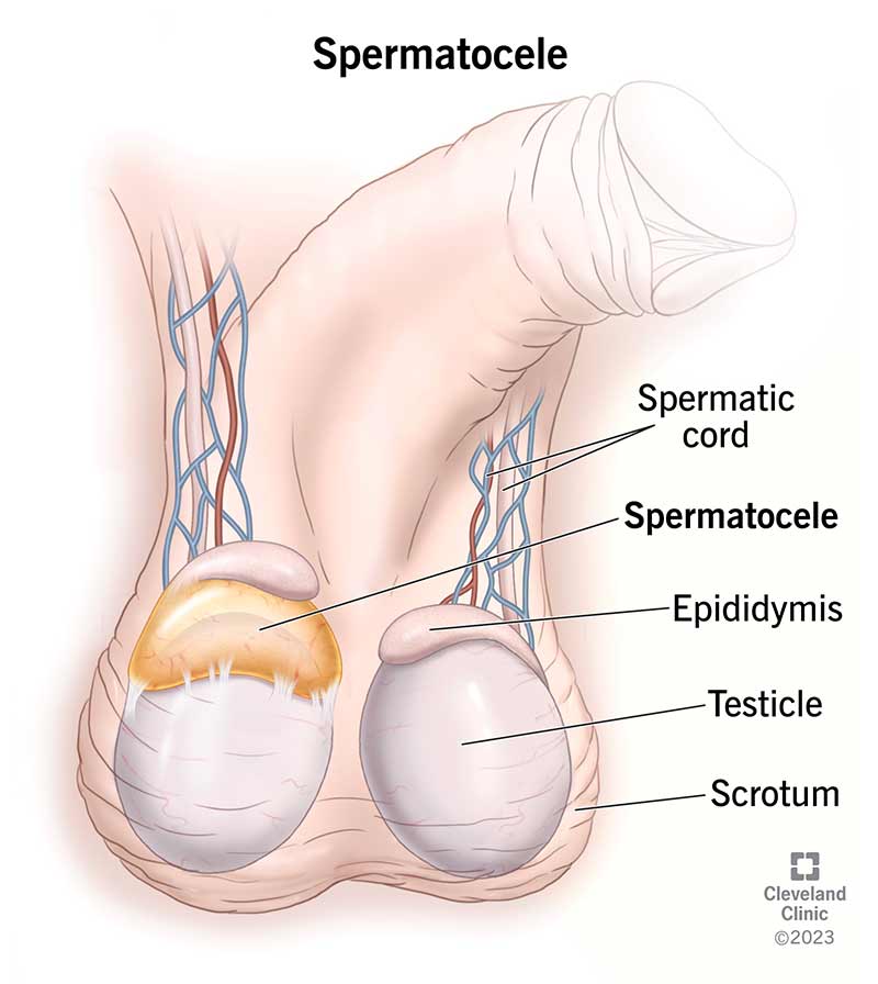 A spermatocele grows along your epididymis, above or behind your testicle.