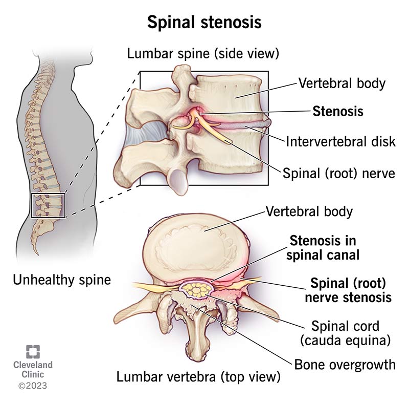 Illustration of lumbar vertebra with spinal stenosis, showing bone overgrowth and nerve irritation.