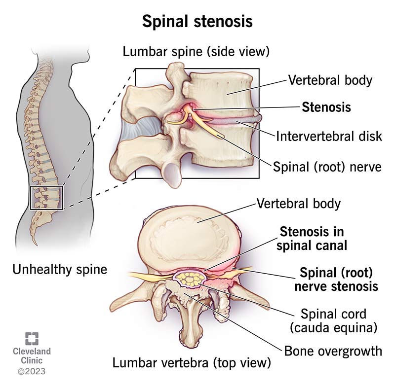 Hereditary multiple exostoses with spinal cord compression.