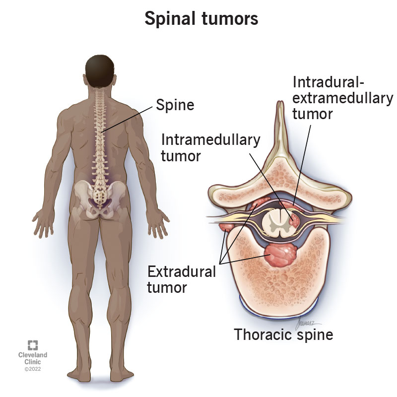 Thoracic Back Pain: Causes, Diagnosis, and Treatment