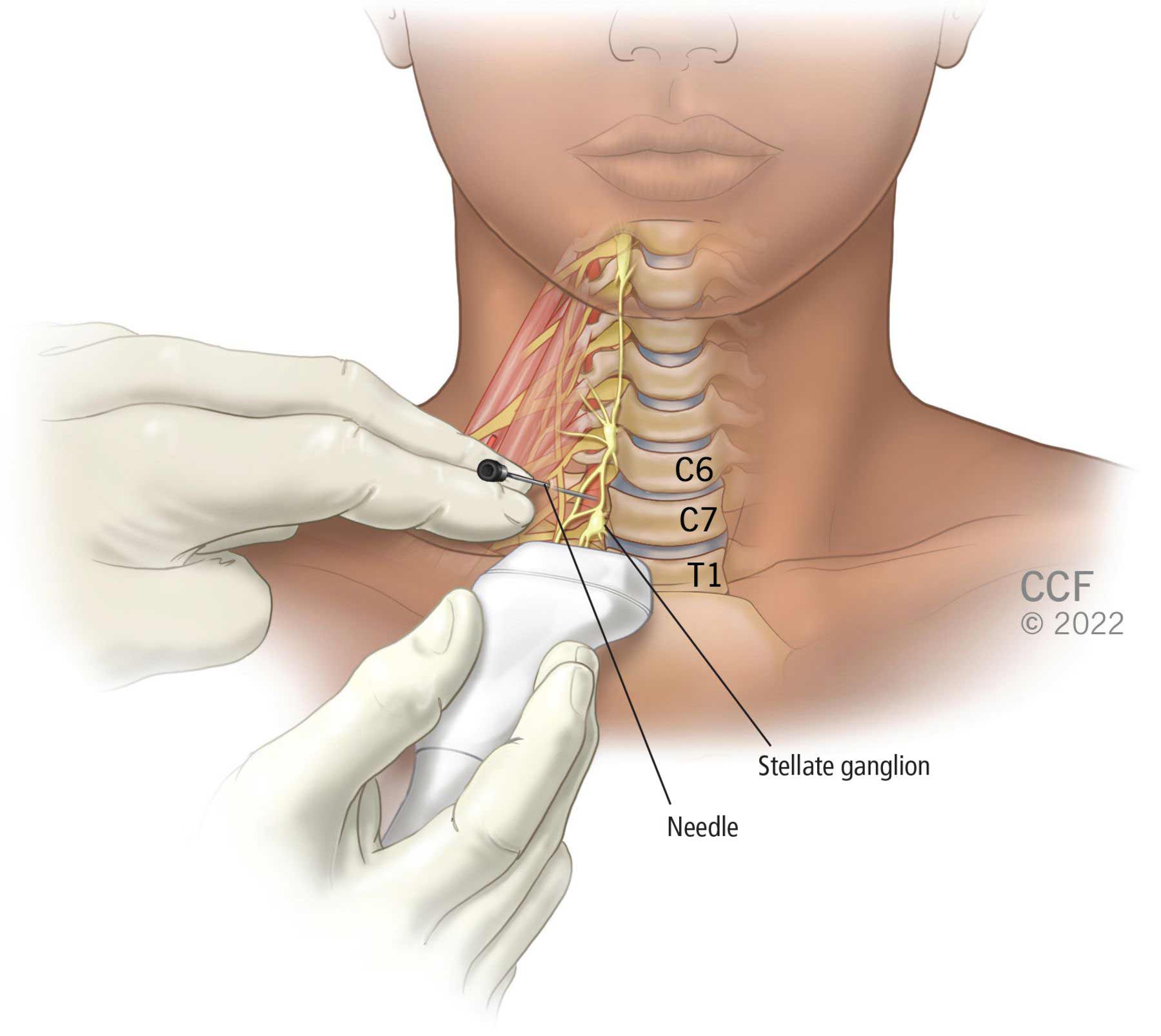 Illustration showing anatomical location of the stellate ganglion, which is on the front side of the neck next to the C7 and T1 vertebrae.