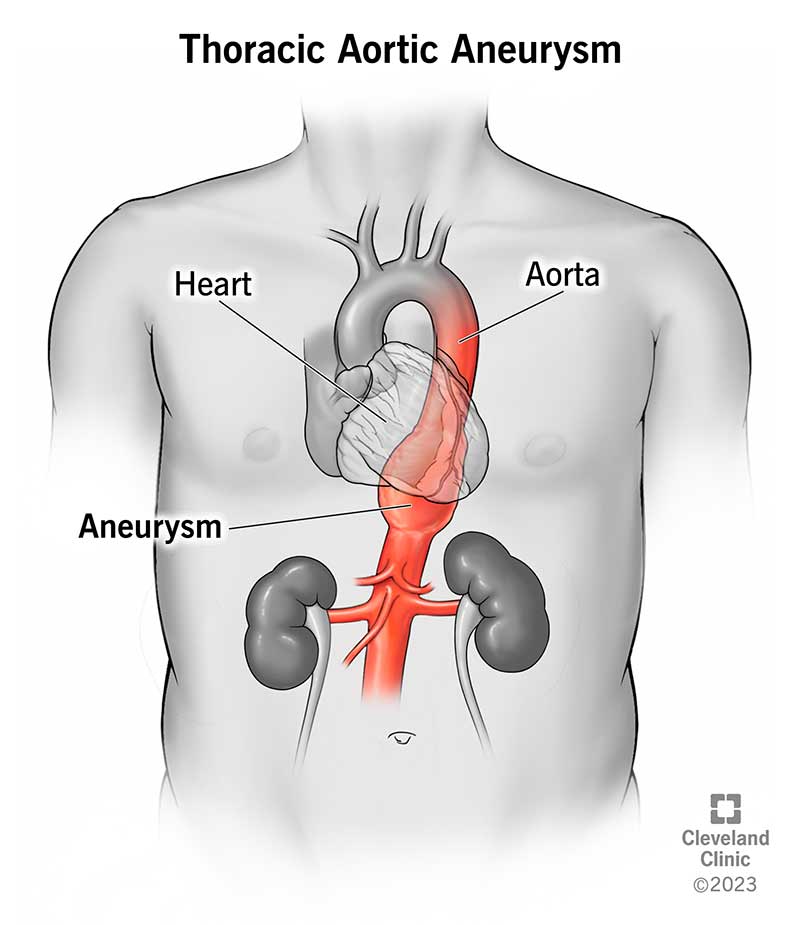 Illustration showing the location of a thoracic aortic aneurysm in a person’s chest.