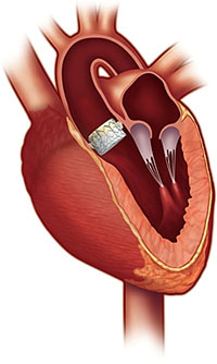 Transcatheter Aortic Valve Replacement (TAVR)