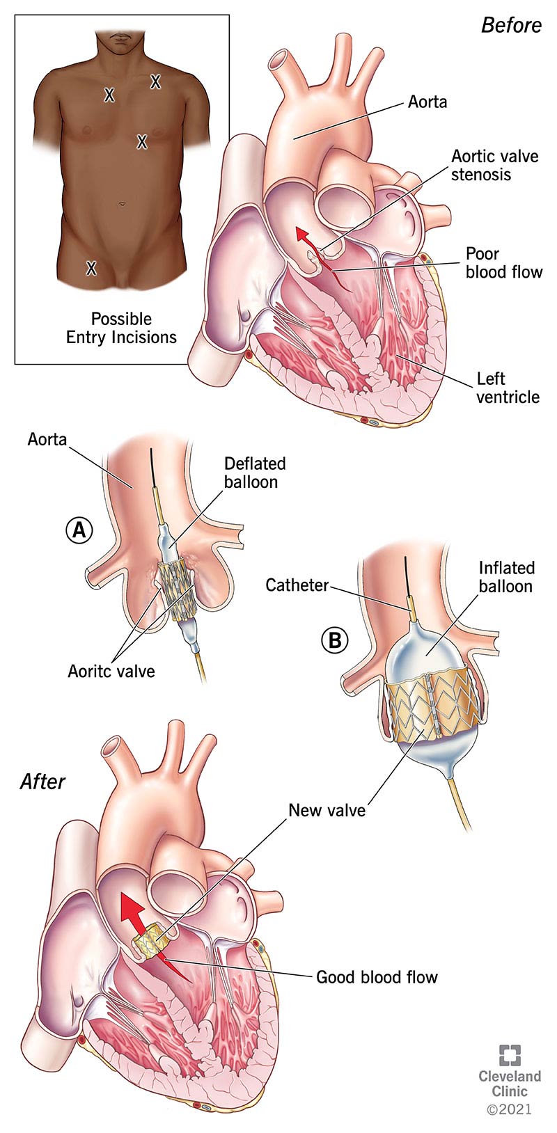 How TAVR replaces an aortic valve from the inside.
