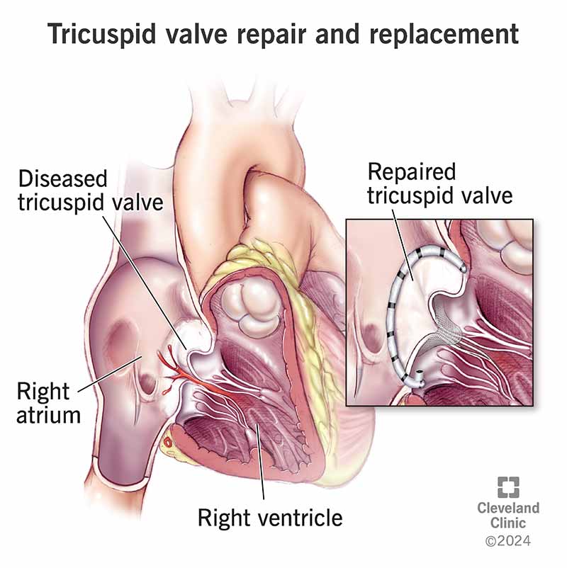 Tricuspid valve repair and replacement help people with a leaky valve or one with stiff leaflets that limit blood flow.